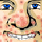 Acne Be Gone! (Oynama:2241)